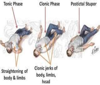 GENERALISED TONIC CLONIC SEIZURES | PPT