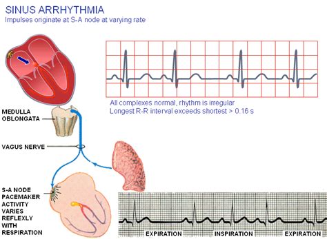 2.D Sinus arrhythmia. | Download Scientific Diagram