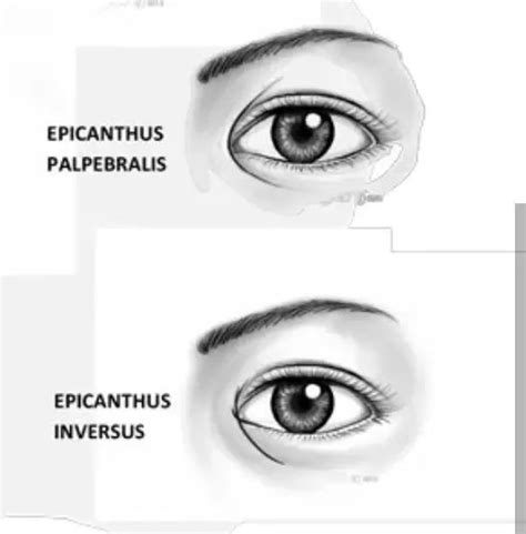 Epicanthus asiatique | Estheticon.fr