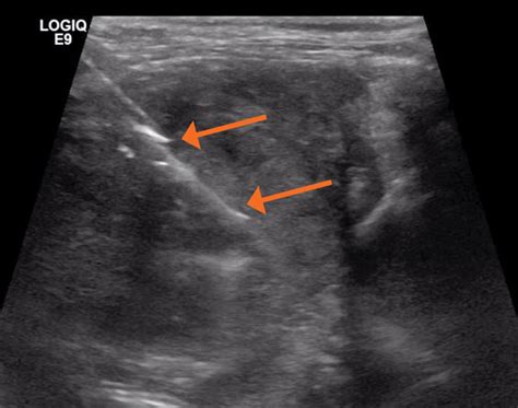 Ultrasound-Guided Fine Needle Aspiration and Core Biopsy - Today's Veterinary Practice