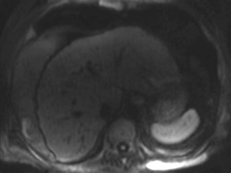 Diffusion-Weighted MRI for Quantification of Liver Fibrosis ...