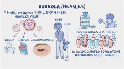 Rubeola (Measles): Nursing - Osmosis Video Library