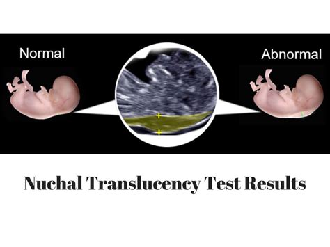 Dr Tee What Are The Screening Tests For Trisomy 21, 18, 13, 47% OFF