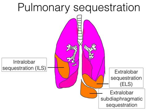 Bronchopulmonary sequestration causes, symptoms, diagnosis, treatment ...