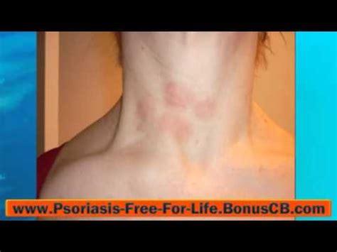 Psoriasis Groin Treatment Psoriasis Hair Loss Treatment - YouTube