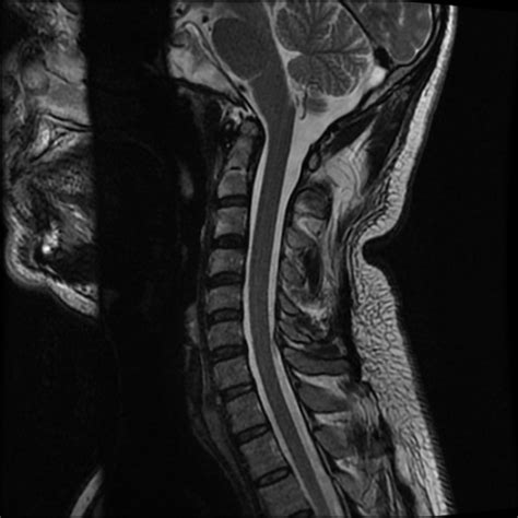 Mri Cervical Spine Neck Pain