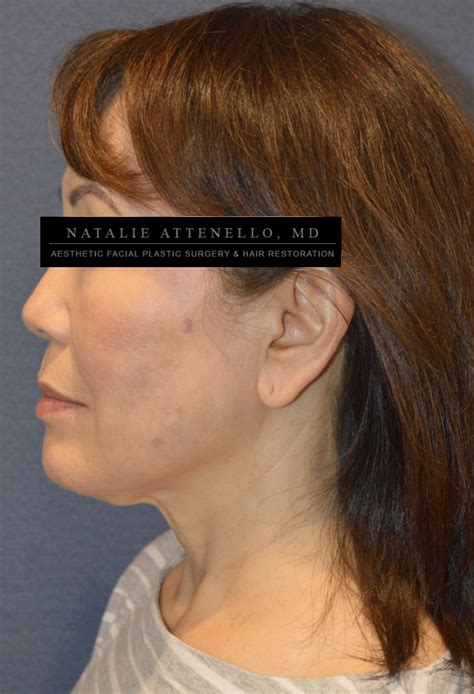 Beverly Hills Facelift Before and After Photos - Los Angeles Plastic ...