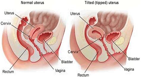 Tilted Uterus - Causes, Symptoms, Diagnosis, Treatment and Pregnancy