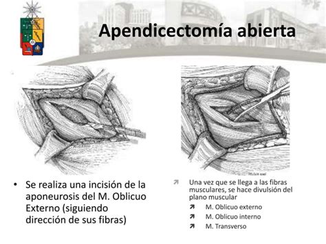 Apendicectomía abierta y vlp