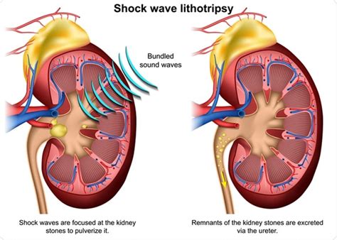 herenciageneticayenfermedad: Shock Wave Lithotripsy Safety and Side Effects