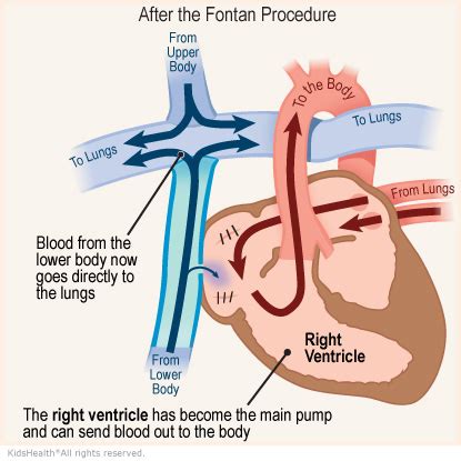 The Fontan Procedure