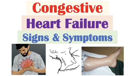 Congestive Heart Failure Signs & Symptoms (& Why They Occur) - YouTube