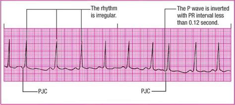 Junctional Tachycardia