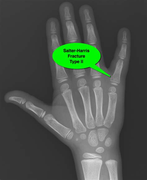 Salter Harris Type 2 Fracture Finger