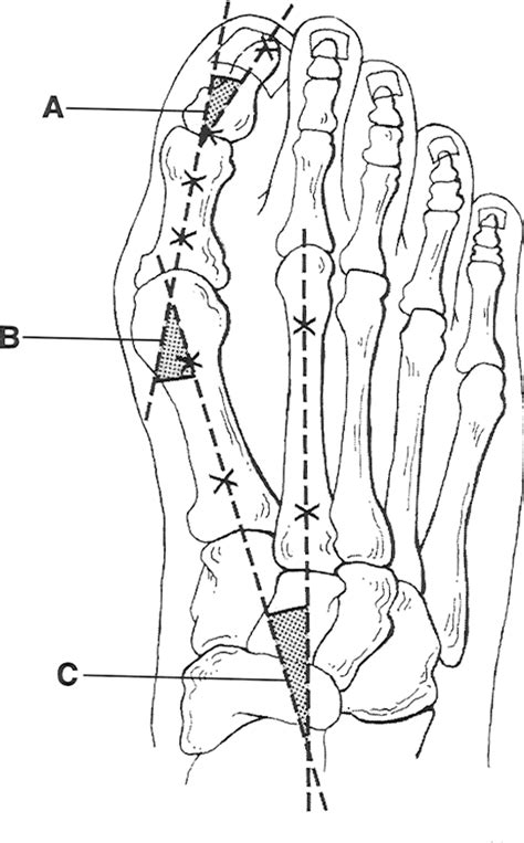 Hallux structure | Semantic Scholar