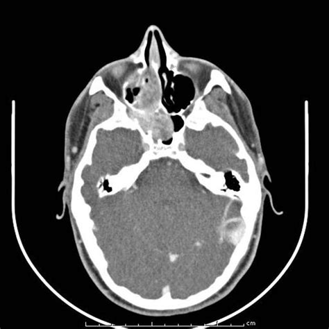 Nasopharyngeal Angiofibroma Radiology