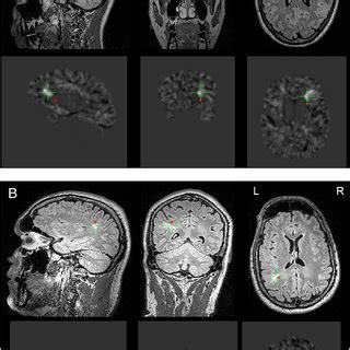 Illustrative MRI examples from bottom-of-sulcus dysplasias (BOS), all ...