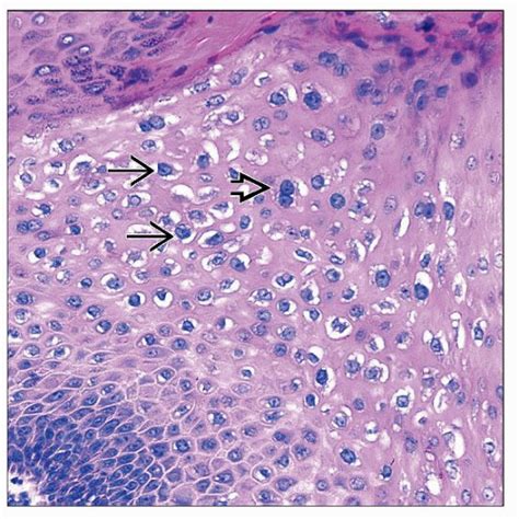 Koilocytes Histology