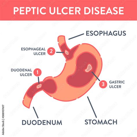 peptic ulcer stomach disease infographic poster. endoscopic image of ...