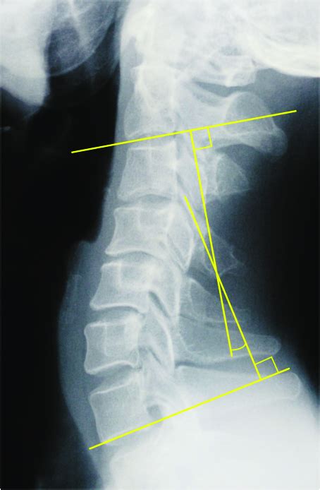 C2-7 Cobb angle measurement. | Download Scientific Diagram