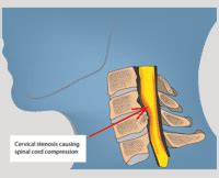 What is Myelopathy? Symptoms & Treatment | Spine & Orthopedic Center