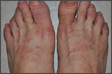 psoriasis on top of feet pictures | Psoriasis expert