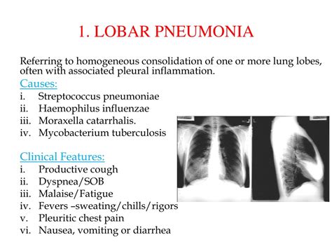 PPT - Pneumonia Radiology PowerPoint Presentation, free download - ID ...