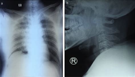 Structural images of a patient in the trauma group. (A) Chest X-ray: no... | Download Scientific ...