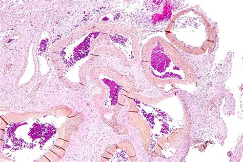 Arteriovenous malformation - Wikipedia