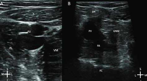 A. Ultrasound image of adductor canal block. S; Sartorius; AL, Adductor ...