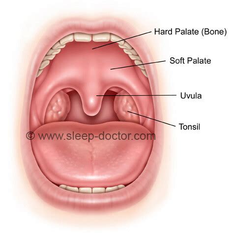 Palate Surgery - Sleep Doctor