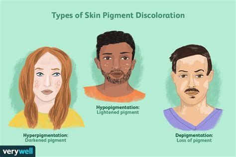 Skin Pigmentation: Genetics, Discoloration, and Treatment