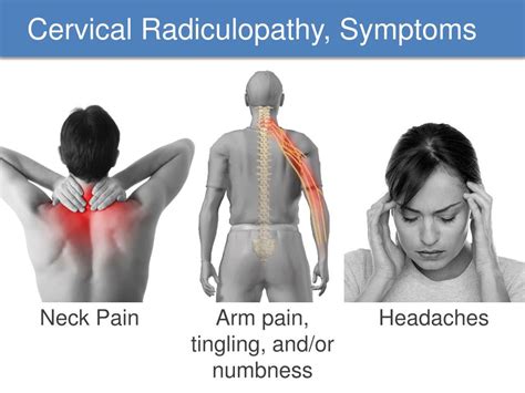 Cervical Radiculopathy Causes Symptoms Diagnosis Treatment | The Best Porn Website