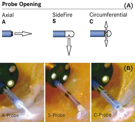 Argon plasma coagulation and radiofrequency ablation in nonvariceal upper gastrointestinal ...