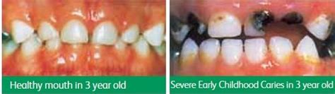 Early Childhood Caries Treatment & Tips | Alux Dental