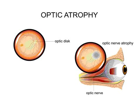 What Are the Signs of Optic Atrophy & How Do You Reverse It? – NVISION ...