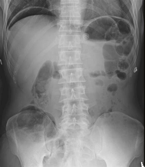 Gastrointestinal perforation x-ray - wikidoc