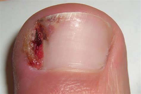 Prevalent Symptoms of Ingrown Toenail | BJIOS Orthopaedics