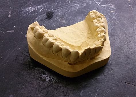 Plaster Cast Dental Models vs 3D Digital Models – Which Are Best? – Trevor Brooker