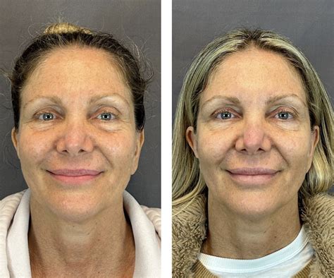 Patient 146416182 | BOTOX Before & After Photos | Austin Face & Body