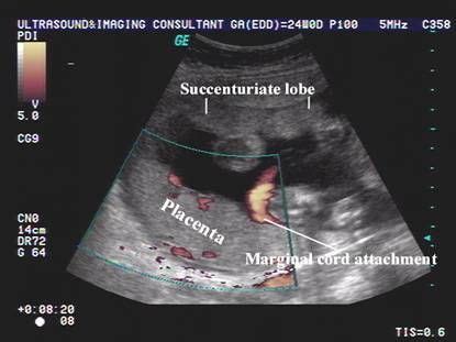 Succenturiate Placenta | Placenta, Medical ultrasound, Ultrasound