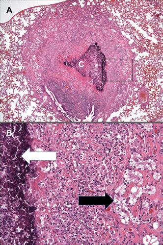 Tuberculosis Histology