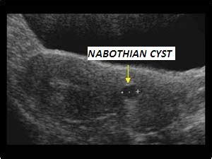 Nabothian Cyst : Cause - Identification -Symptoms - Complications - Diagnosis - Treatment ...