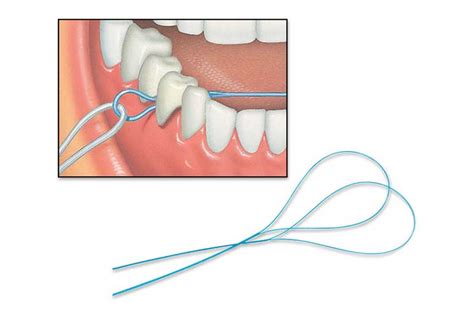 How to Floss with Braces: Effective Techniques for Oral Health