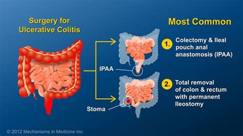 Pin on Surgery and IBD