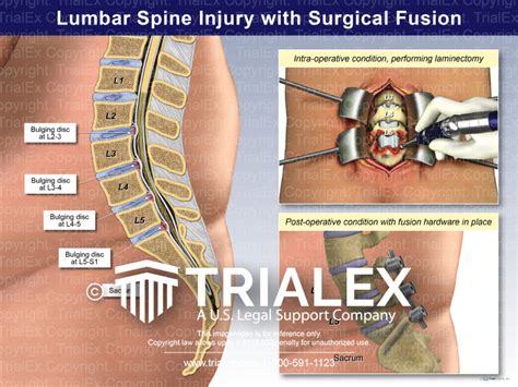 Lumbar Spine Injury with Surgical Fusion - TrialExhibits Inc.