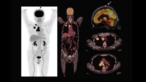 Current role of PET/CT in evaluation of lung cancer - Siemens Healthineers