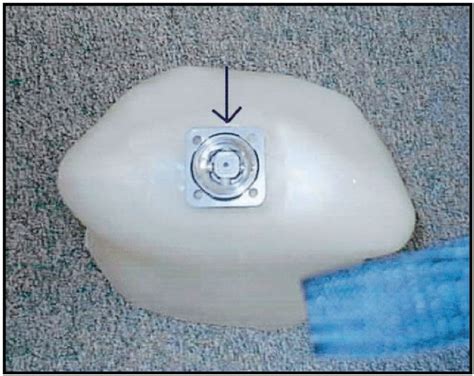 Figure 3 from Musculoskeletal deterioration and hemicorporectomy after spinal cord injury ...