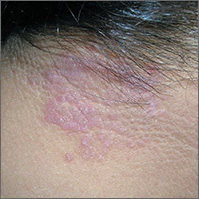 Itchy rash on neck | MDedge Family Medicine