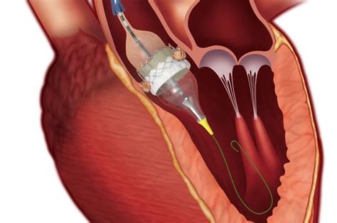 Conscious sedation is a safe alternative to general anesthesia for ...